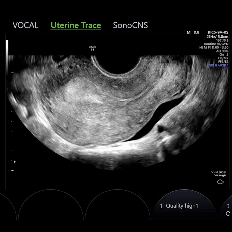 Uterine Trace